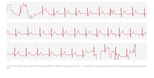 Apple Watch: EKG/ECG